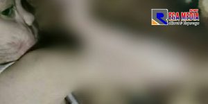 Butuh Uluran Tangan, Sani Bocah Asal Ciwidey Mengalami Luka Bakar Ledakan Tabung Gas