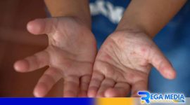Caption: ilustrasi monkeypox. 