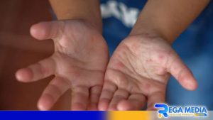 Warga Sampang Diimbau Waspada Virus Cacar Monyet