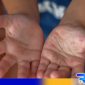 Caption: ilustrasi monkeypox. 